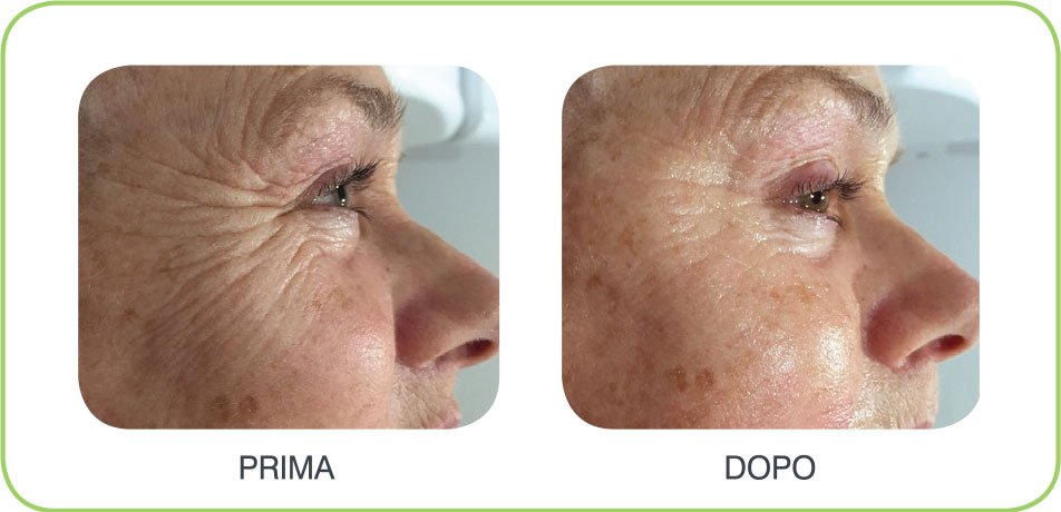 caci-prima-dopo-1