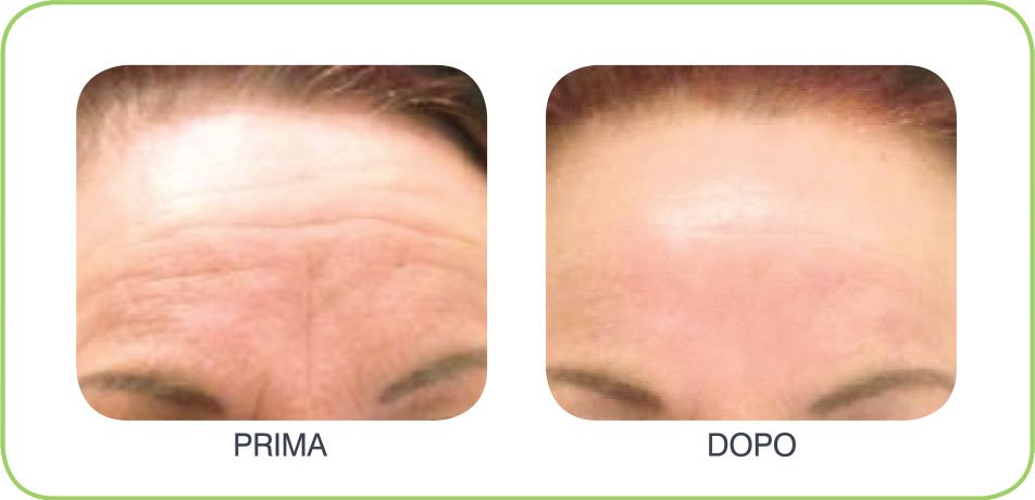 caci-prima-dopo-2