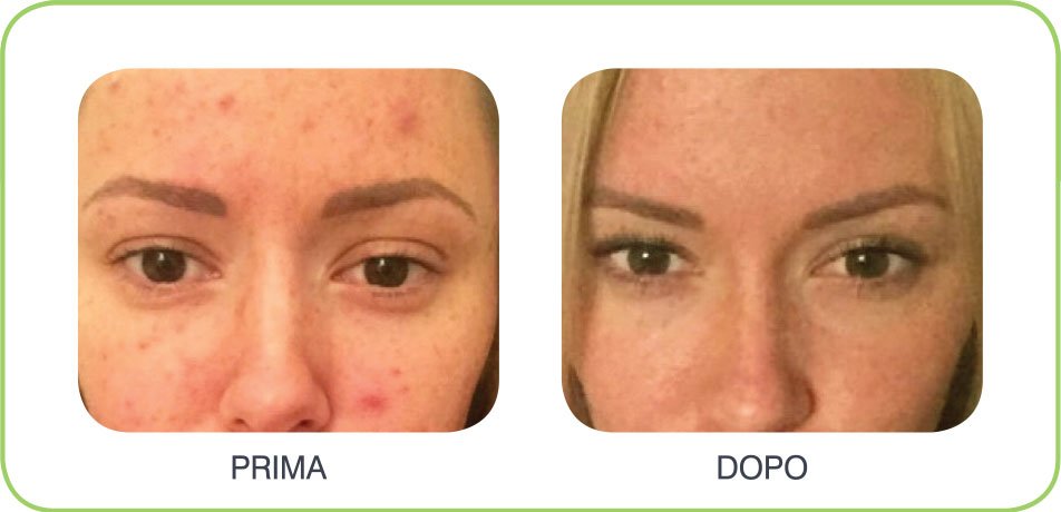caci-prima-dopo-3